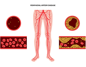말초동맥질환