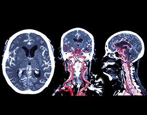 뇌동맥류